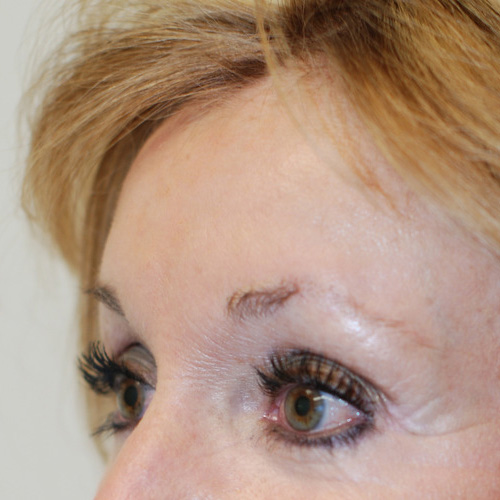 Brow-Lift-03 | After Brow Lift 2