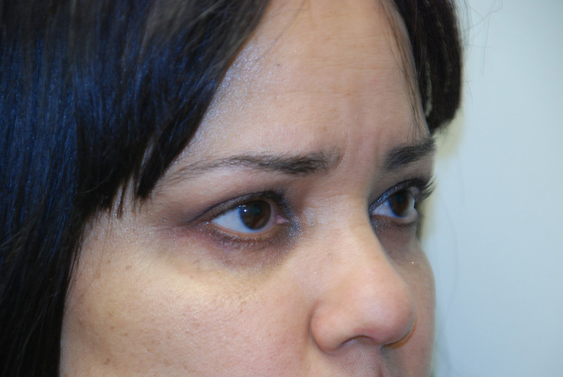 Eyelid-Surgery-05 | After Eyelid Surgery 2