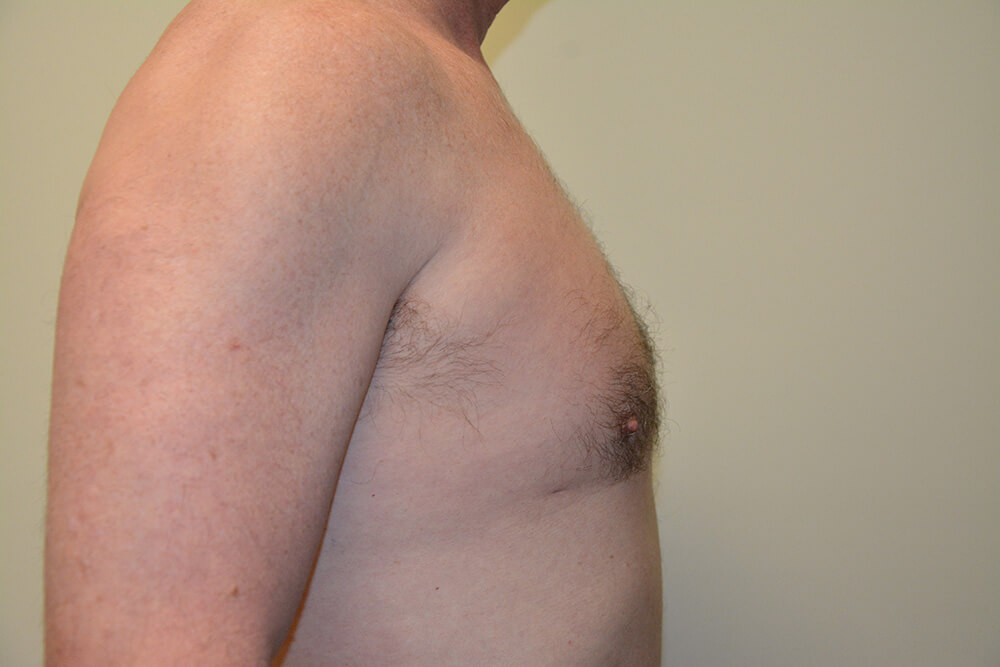 Male-Breast-Reduction-03 | After Male Breast Reduction 3