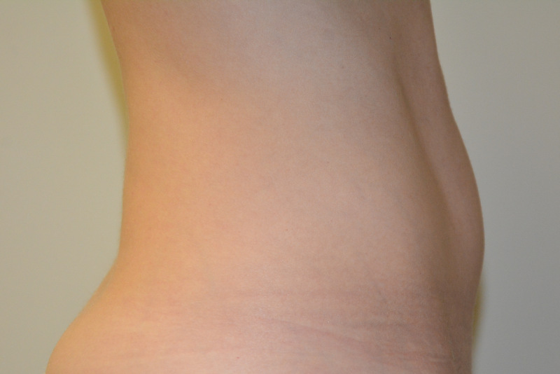 Mini-Tummy-Tuck-03 | After Mini Tummy Tuck 3