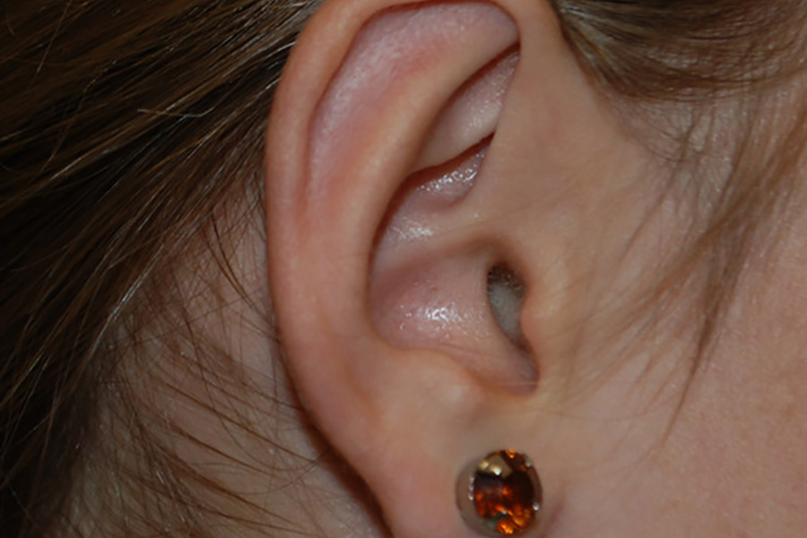 Prominent-Ear-Surgery-03 | After Prominent Ear Surgery 3