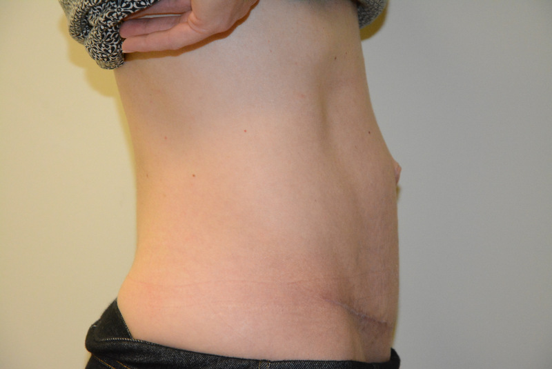 Tummy-Tuck-04 | After Tummy Tuck 3