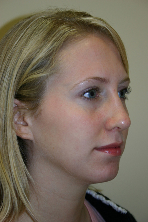 Rhinoplasty-03 | After Rhinoplasty 4