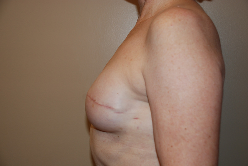 Breast-Reconstruction-Immediate-Implant-03 | After Breast Reconstruction Immediate Implant 5
