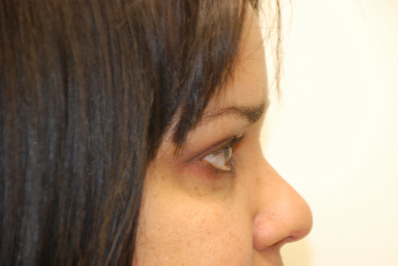 Eyelid-Surgery-05 | After Eyelid Surgery 4