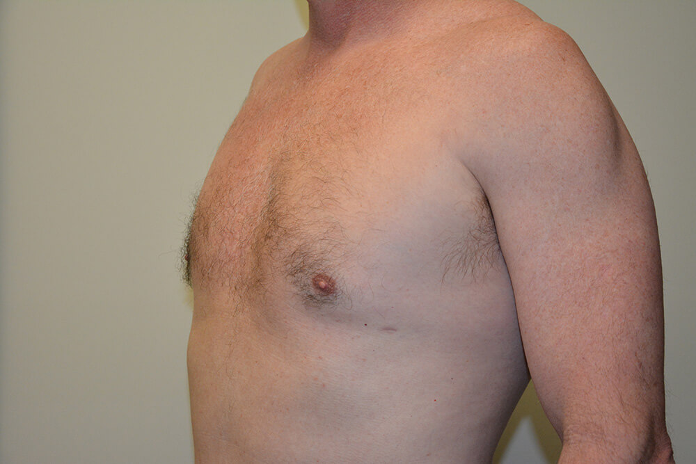 Male-Breast-Reduction-03 | After Male Breast Reduction 4