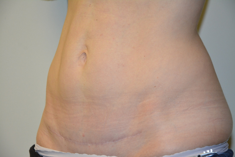 Mini-Tummy-Tuck-03 | After Mini Tummy Tuck 4