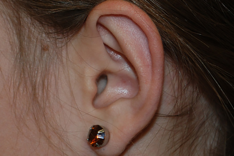 Prominent-Ear-Surgery-03 | After Prominent Ear Surgery 4