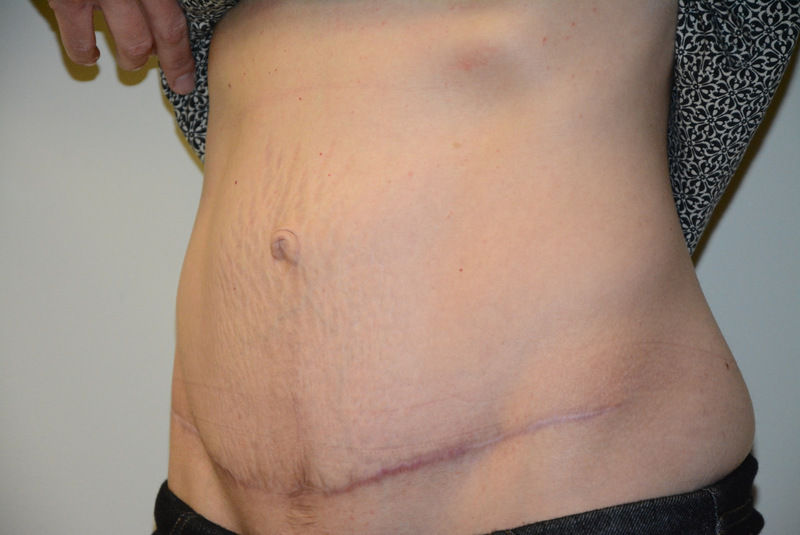 Tummy-Tuck-04 | After Tummy Tuck 4