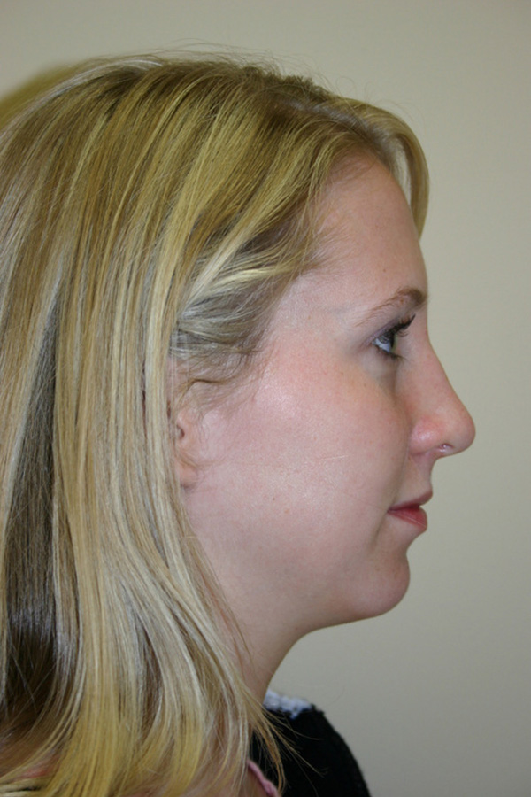 Rhinoplasty-03 | After Rhinoplasty 5