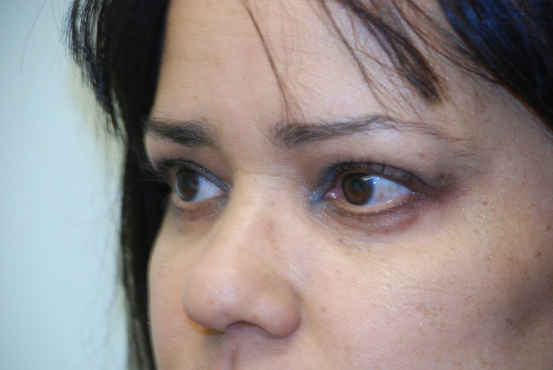 Eyelid-Surgery-05 | After Eyelid Surgery 3
