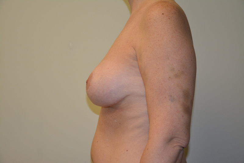 Breast-Lift-03 | After Breast Lift 5
