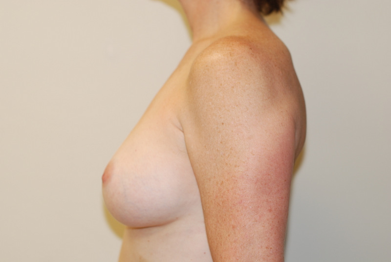 Breast-Augmentation-03 | After Breast Augmentation 3