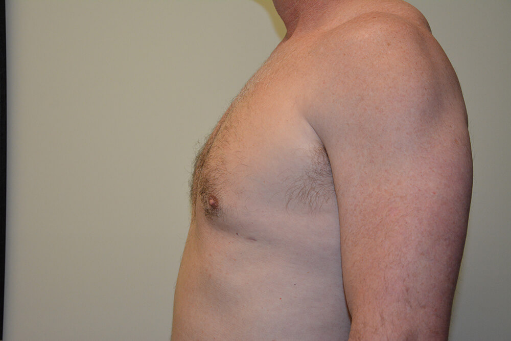 Male-Breast-Reduction-03 | After Male Breast Reduction 5