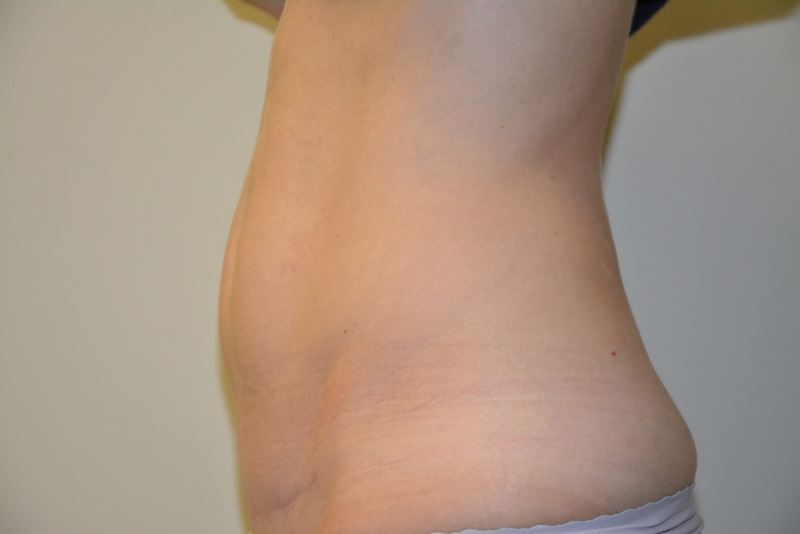 Mini-Tummy-Tuck-03 | After Mini Tummy Tuck 5