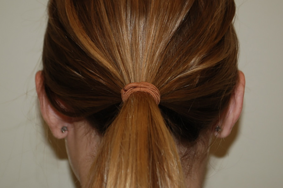 Prominent-Ear-Surgery-03 | After Prominent Ear Surgery 5