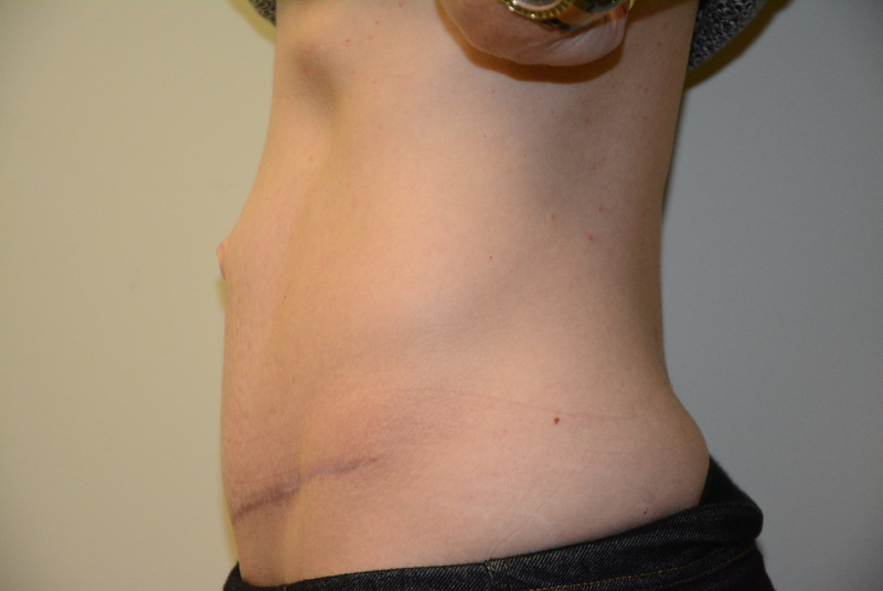 Tummy-Tuck-04 | After Tummy Tuck 5