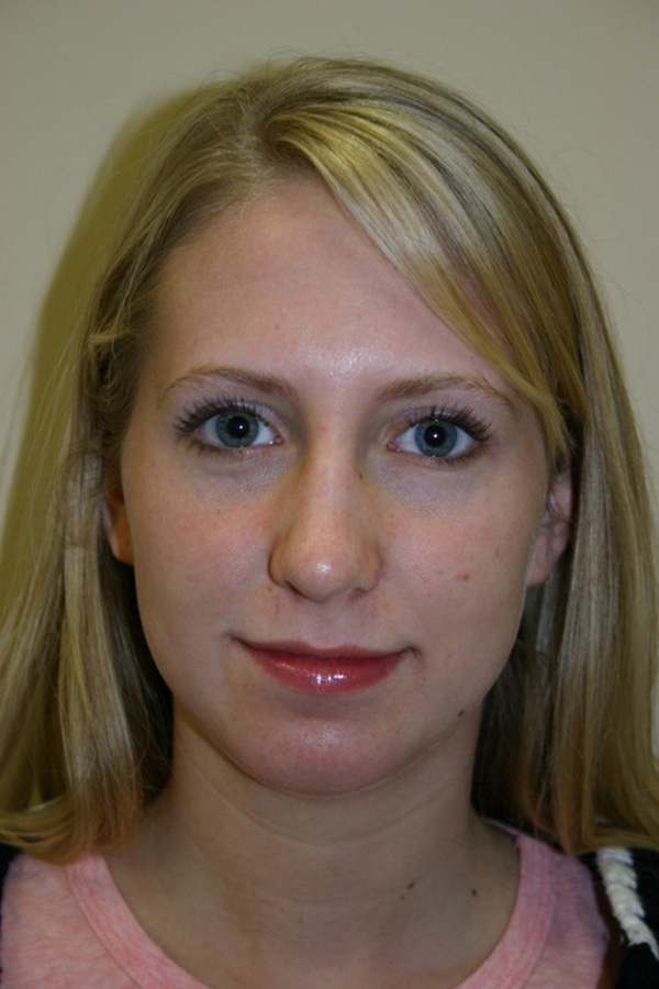 Rhinoplasty-03 | After Rhinoplasty