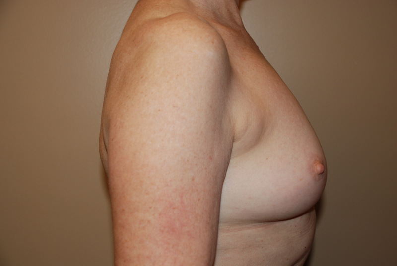Breast-Reconstruction-Immediate-Implant-03 | After Breast Reconstruction Immediate Implant 3