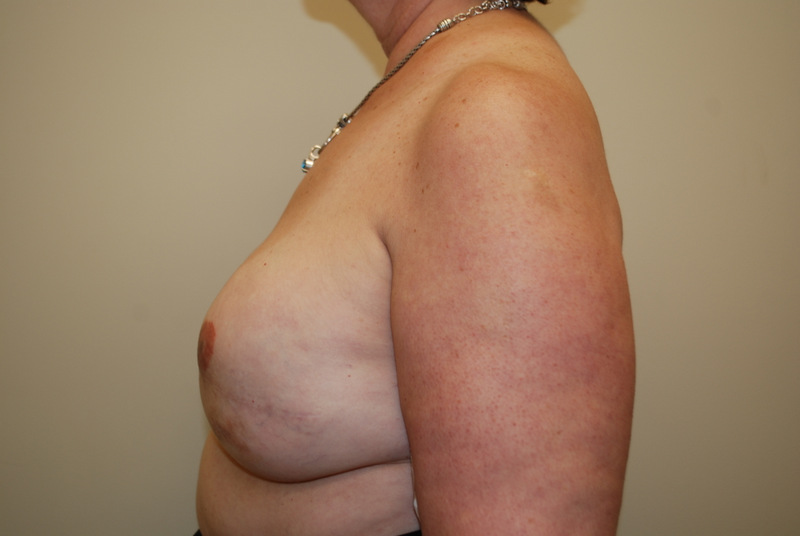 Breast-Reconstruction-Tissue-Expander-03 | After Breast Reconstruction Tissue Expanders 5