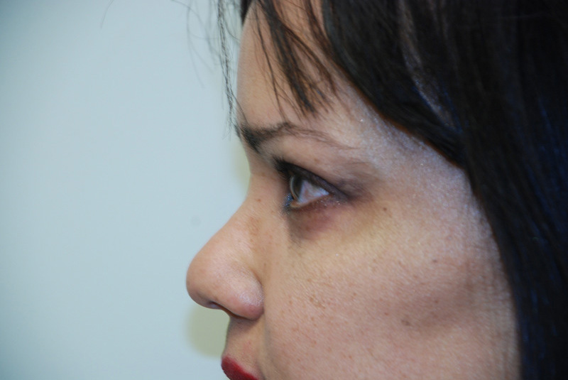 Eyelid-Surgery-05 | After Eyelid Surgery 5