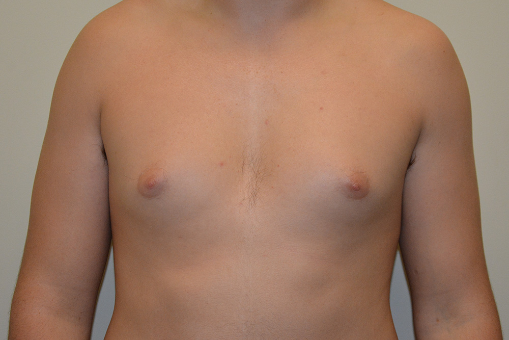 Male-Breast-Reduction-04 | Before Male Breast Reduction