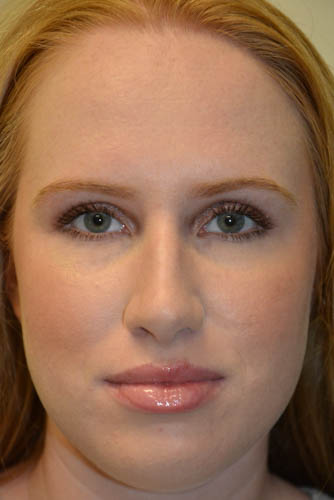 Rhinoplasty-04 | Before Rhinoplasty