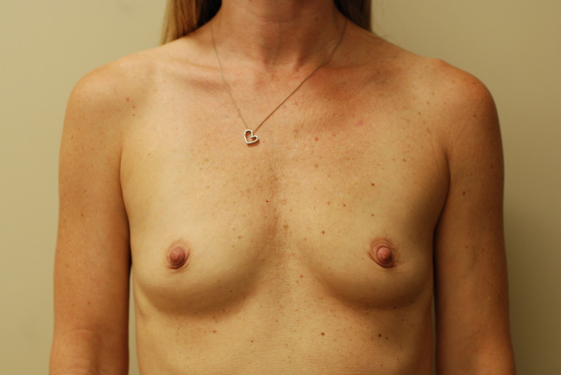 Breast-Augmentation-04 | Before Breast Augmentation