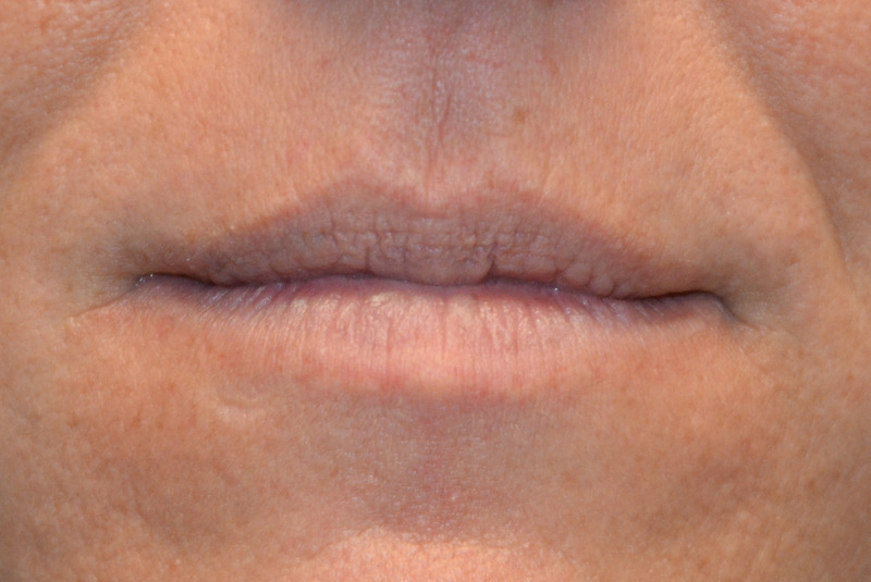 Injectable-Fillers-04 | Before Injectable Fillers