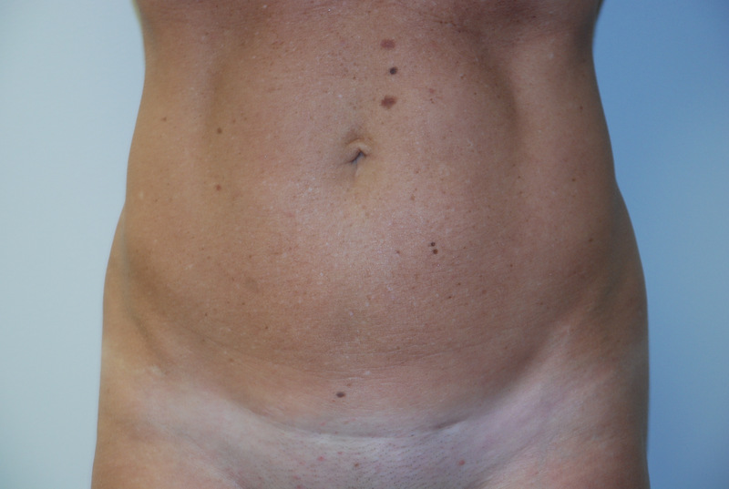 Mini-Tummy-Tuck-04 | Before Mini Tummy Tuck 1