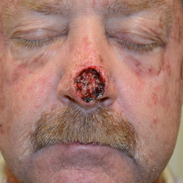Skin-Cancer-Reconstruction-04 | Before Skin Cancer Reconstruction 2