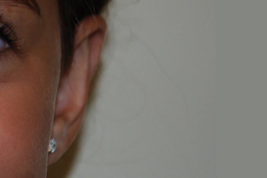 Prominent-Ear-Surgery-04 | After Prominent Ear Surgery 2