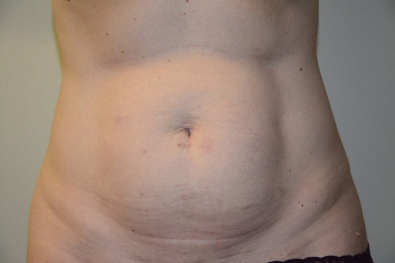 Tummy-Tuck-05 | Before Tummy Tuck