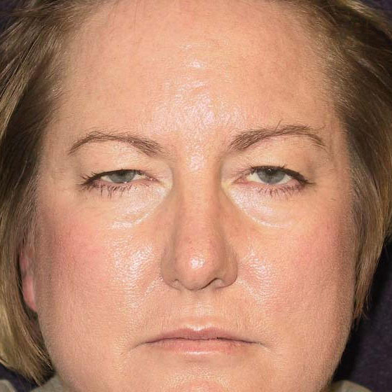 Brow-Lift-04 | Before Brow Lift