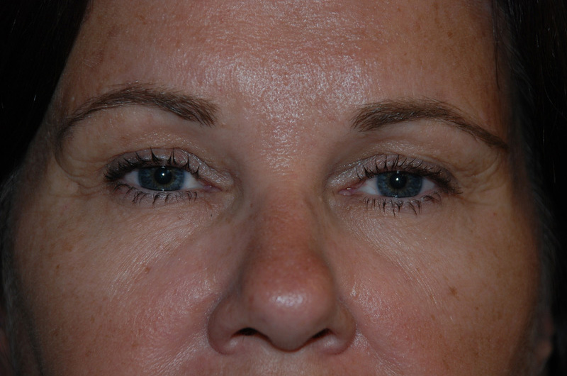 Eyelid-Surgery-04 | Before Eyelid Surgery 1