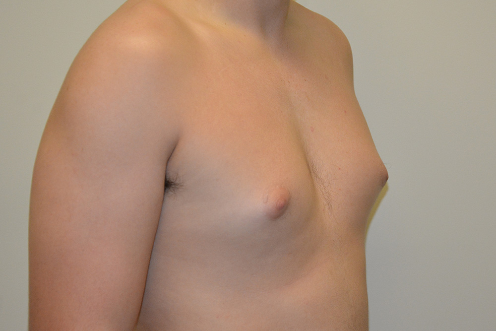 Male-Breast-Reduction-04 | Before Male Breast Reduction 2
