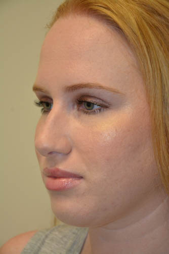 Rhinoplasty-04 | Before Rhinoplasty 2