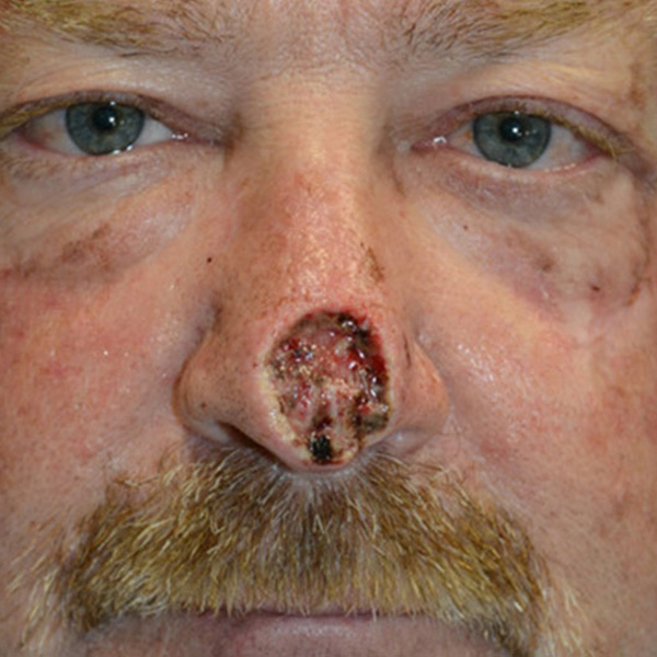 Skin-Cancer-Reconstruction-04 | Before Skin Cancer Reconstruction