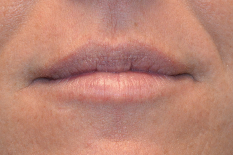 Injectable-Fillers-04 | After Injectable Fillers