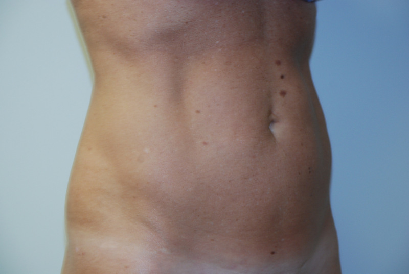 Mini-Tummy-Tuck-04 | Before Mini Tummy Tuck 2