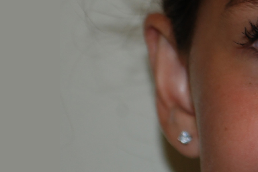 Prominent-Ear-Surgery-04 | After Prominent Ear Surgery