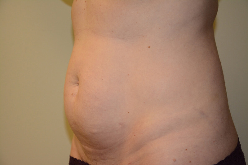 Tummy-Tuck-05 | Before Tummy Tuck 2
