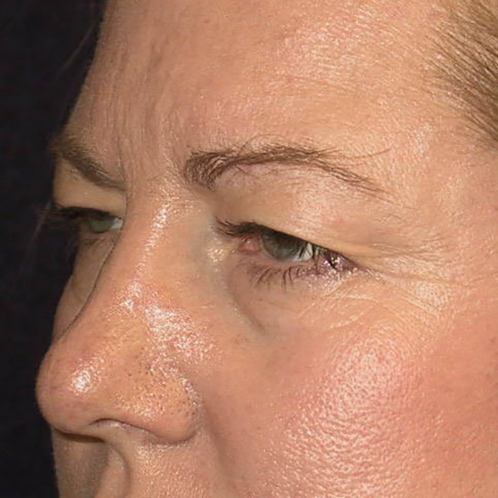 Brow-Lift-04 | Before Brow Lift 2