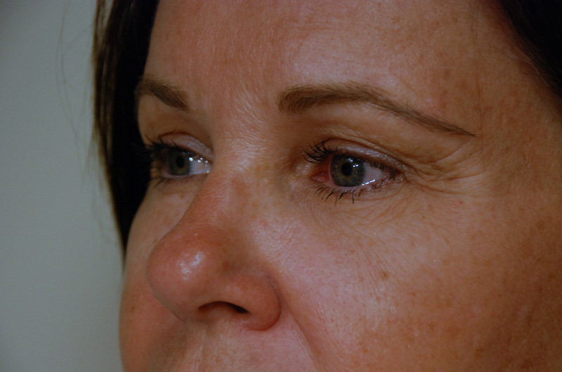 Eyelid-Surgery-04 | Before Eyelid Surgery 2