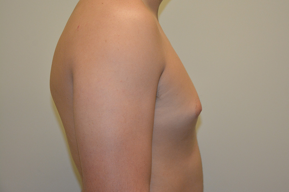 Male-Breast-Reduction-04 | Before Male Breast Reduction 3