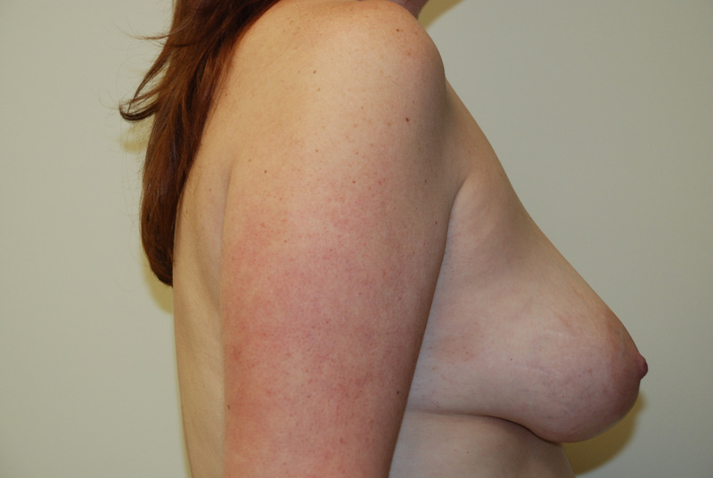 Breast-Lift-04 | Before Breast Lift 3