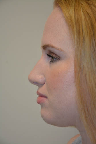 Rhinoplasty-04 | Before Rhinoplasty 3