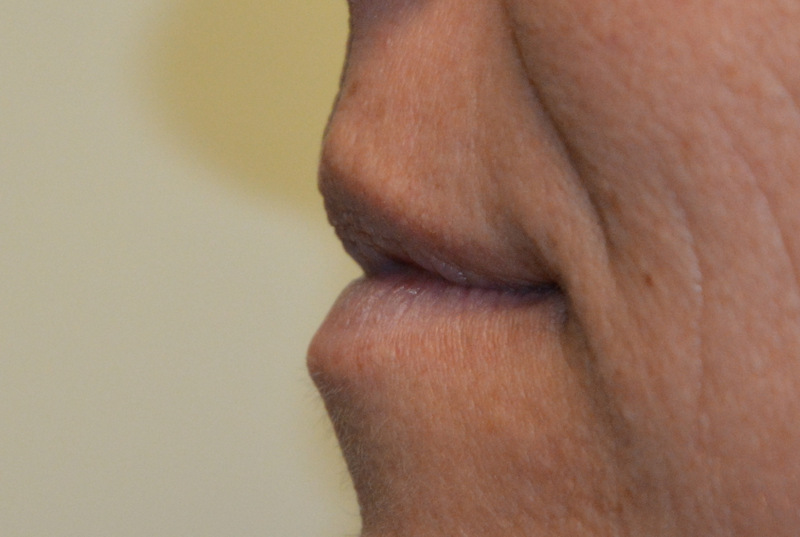 Injectable-Fillers-04 | Before Injectable Fillers 2