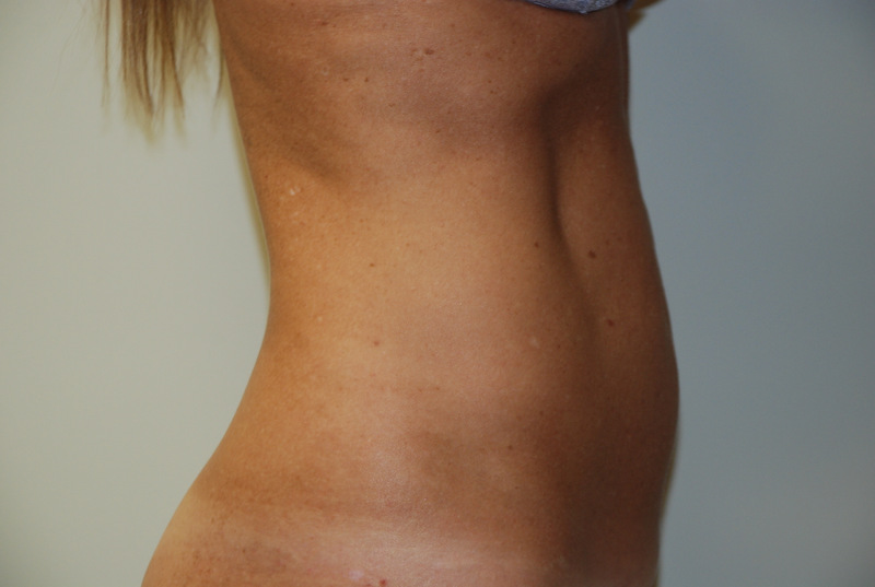 Mini-Tummy-Tuck-04 | Before Mini Tummy Tuck 3
