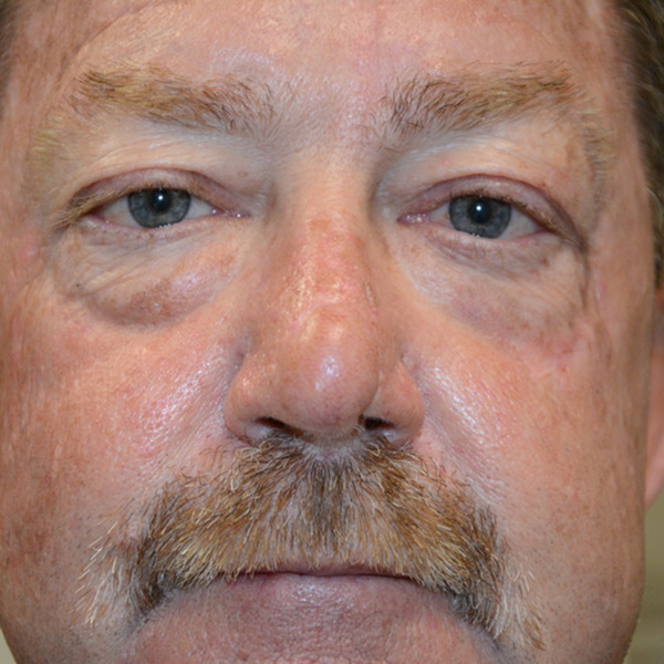 Skin-Cancer-Reconstruction-04 | After Skin Cancer Reconstruction 2